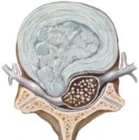 Hernie discale 1